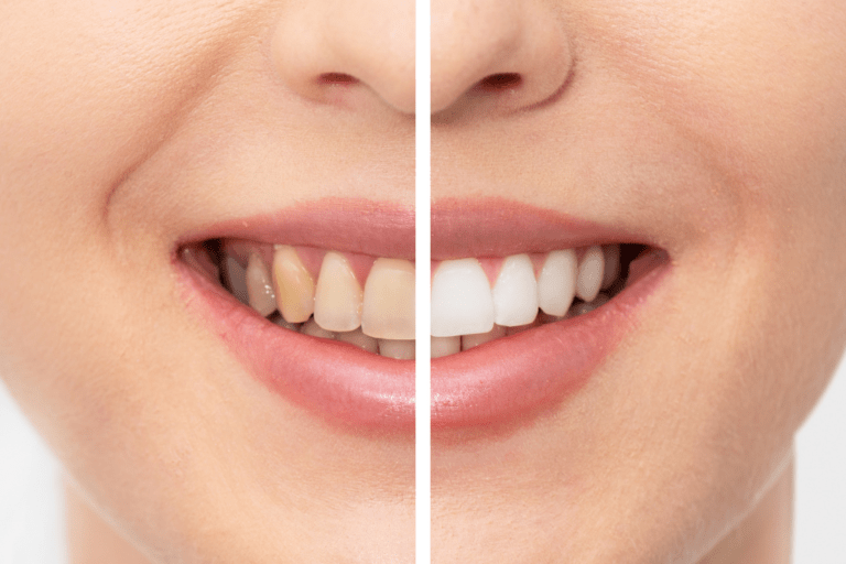 How much does teeth whitening cost at Dentists in Surrey Hills?