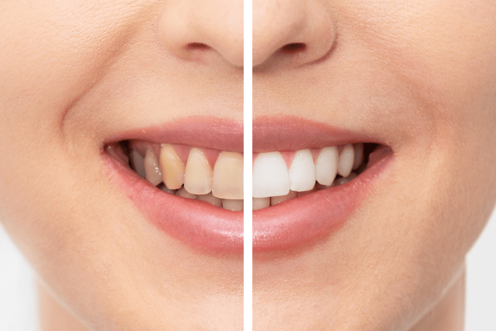 How much does teeth whitening cost at Dentists in Surrey Hills?