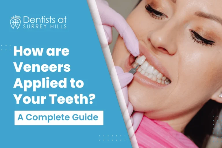 how are veneers applied?