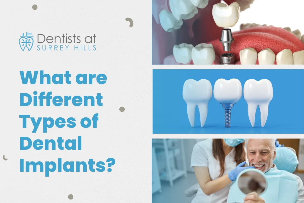 Types of Dental Implants