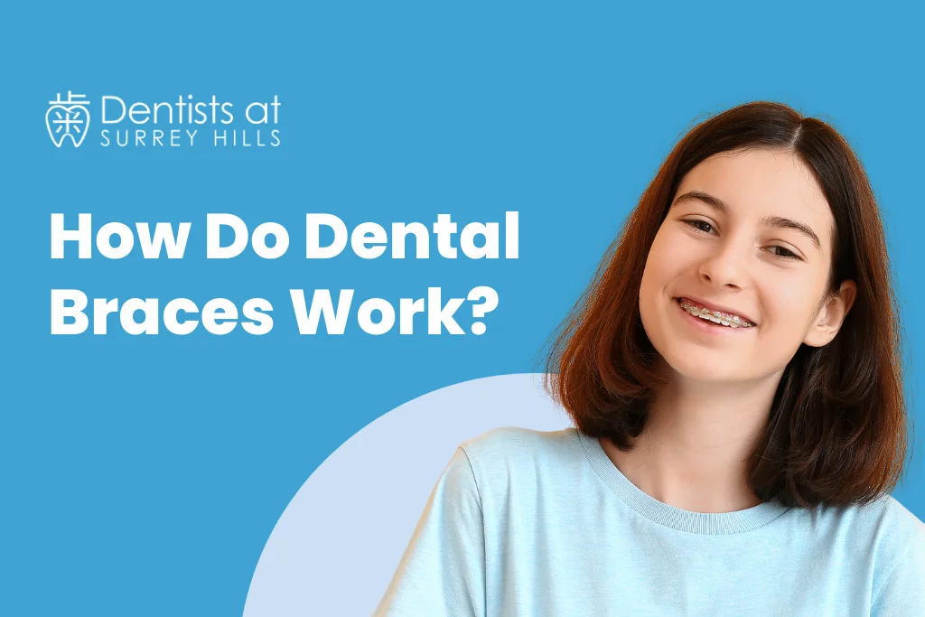 How Do Dental Braces Work