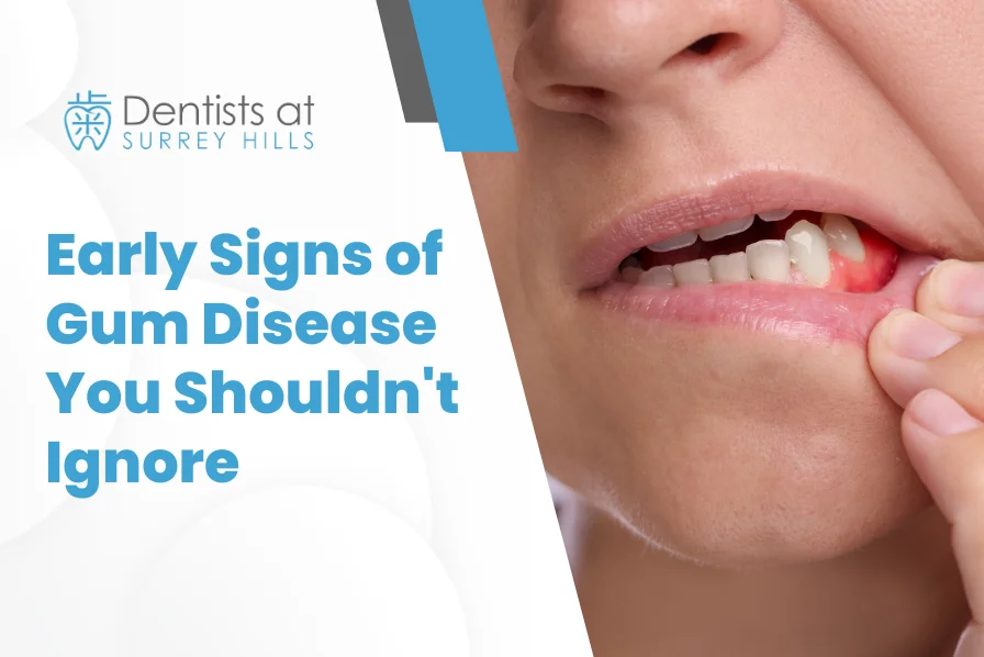 Early Signs of Gum Disease You Shouldn't Ignore